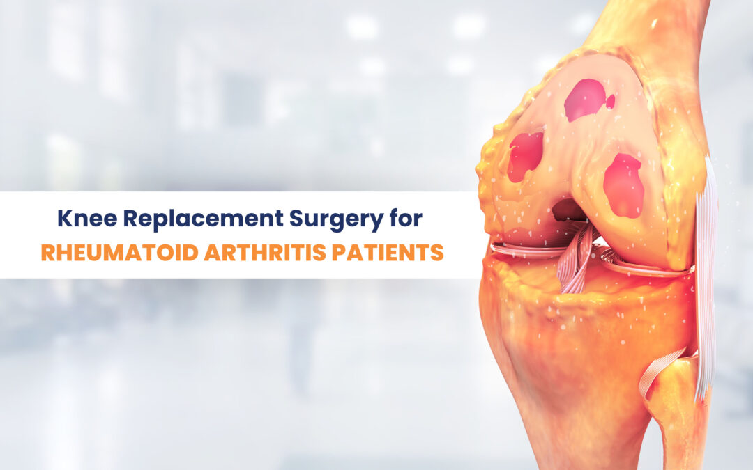 A depiction of knee replacement surgery tailored for individuals with rheumatoid arthritis.