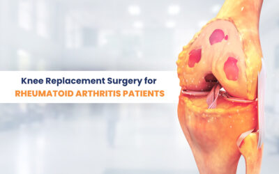 Knee Replacement Surgery for Rheumatoid Arthritis Patients: A Game-Changer for Mobility!