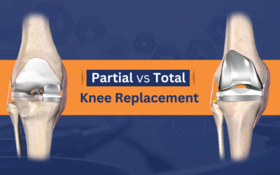 Partial and Total Knee Replacement: Which Is Better?