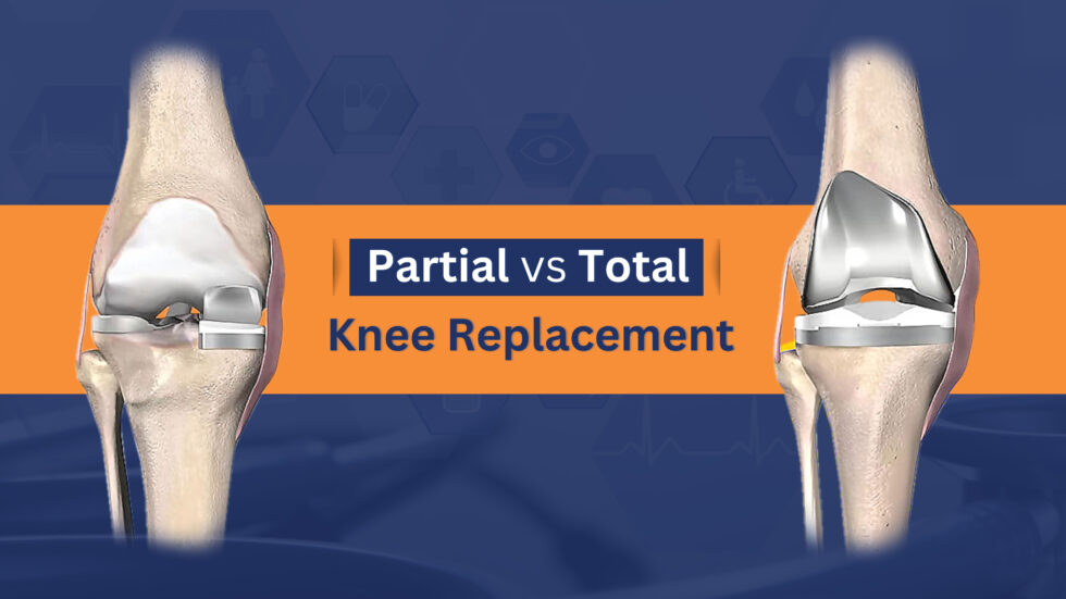 Partial Vs. Total Knee Replacement: Which Is Better? - Wellness Hospitals