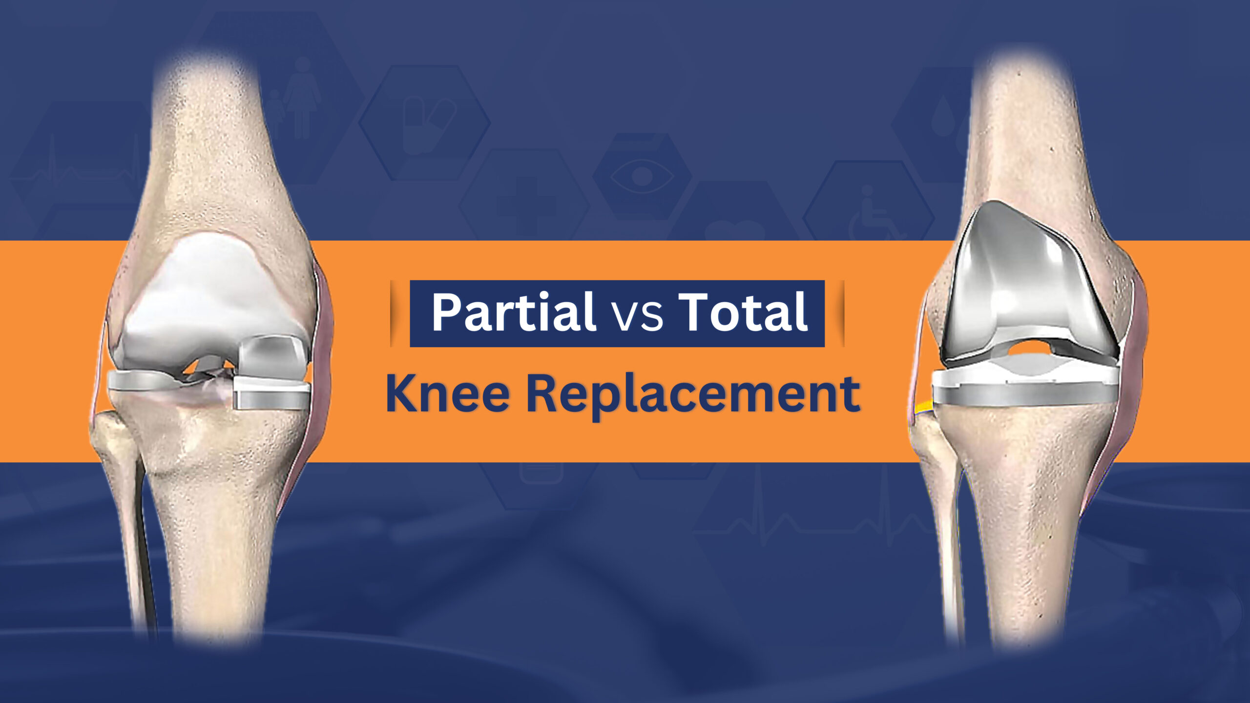 Partial And Total Knee Replacement Which Is Better Wellness Hospitals