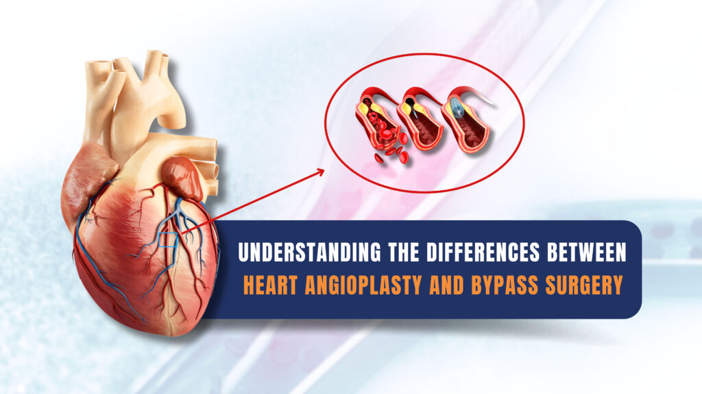 Understanding the Differences Between Heart Angioplasty and Bypass