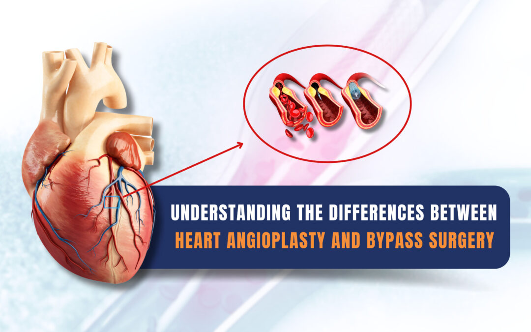 Understanding the Differences Between Heart Angioplasty and Bypass Surgery