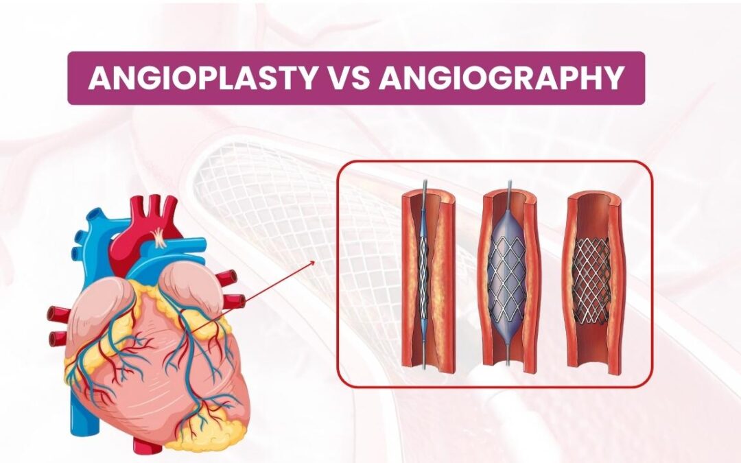 Comparison of Angioplasty vs. Angiography procedures explained by a cardiologist.