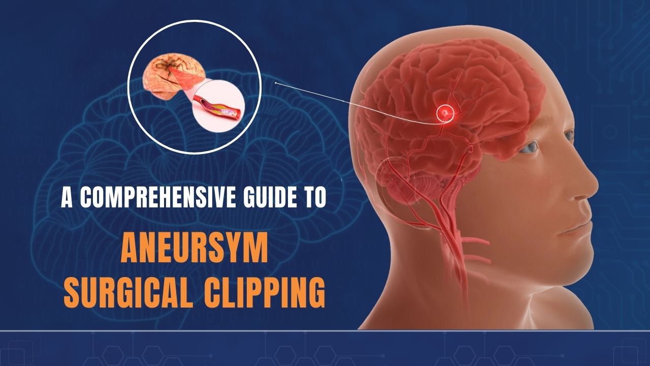 Aneurysm Mastery: Step-by-Step Guide to Surgical Clipping - Wellness ...