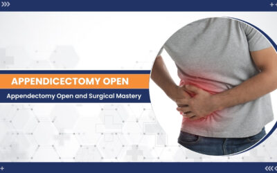 A Comprehensive Guide to Appendectomy Open and Appendicitis Recovery