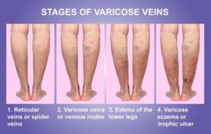 4 Stages Of Varicose Veins