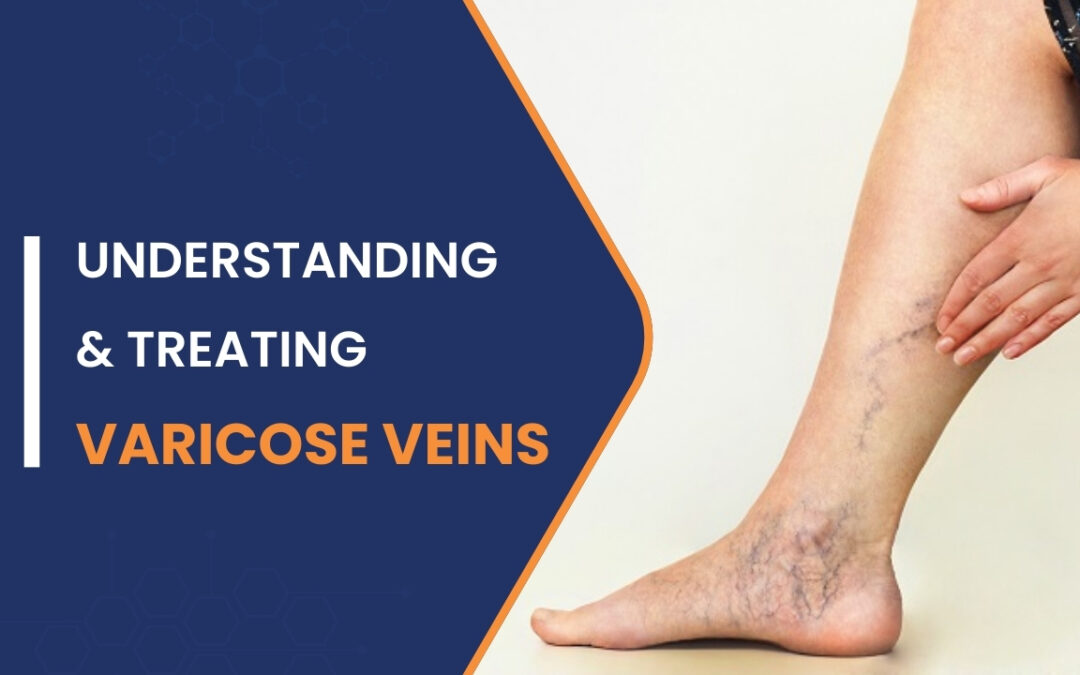 Varicose veins self care