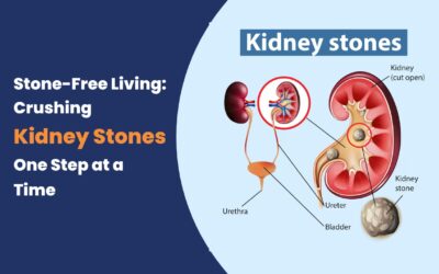 Best Hospital for Kidney Stone Treatment in Hyderabad