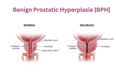 Best Hospital for Prostate Treatment in Hyderabad